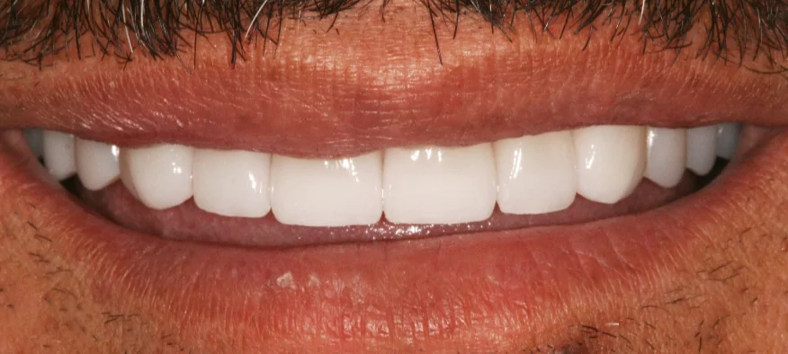 After Treatment Case 1