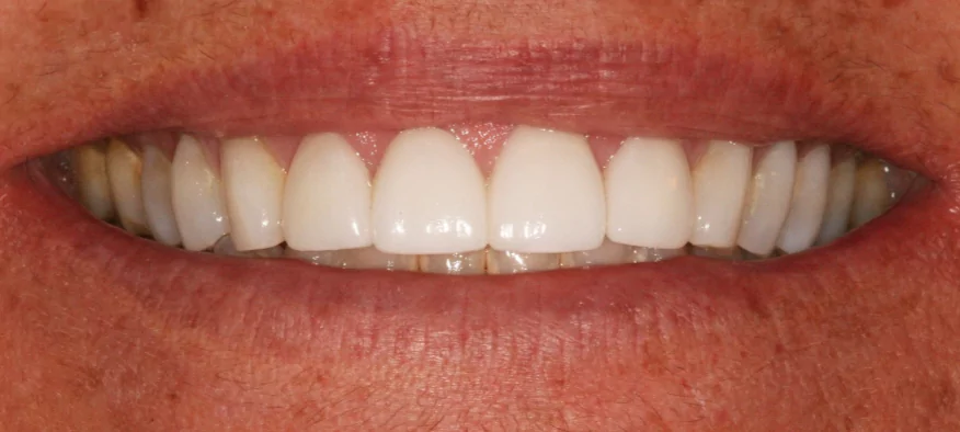 After Treatment Case 2