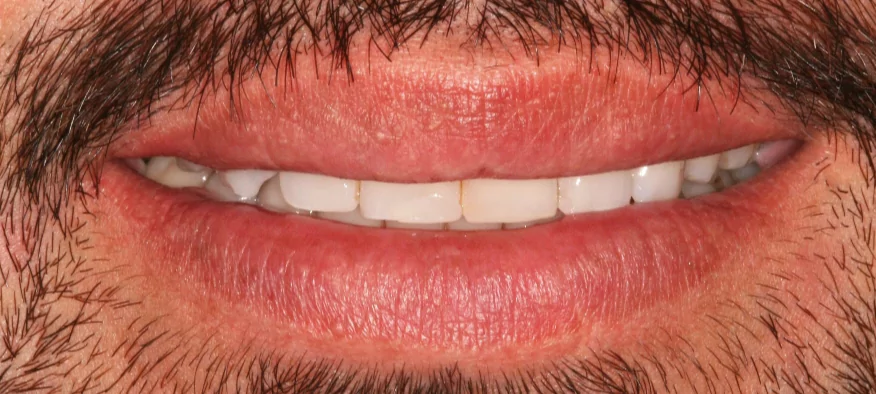After Treatment Case 3