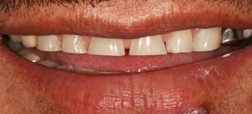 Before Treatment Case 1