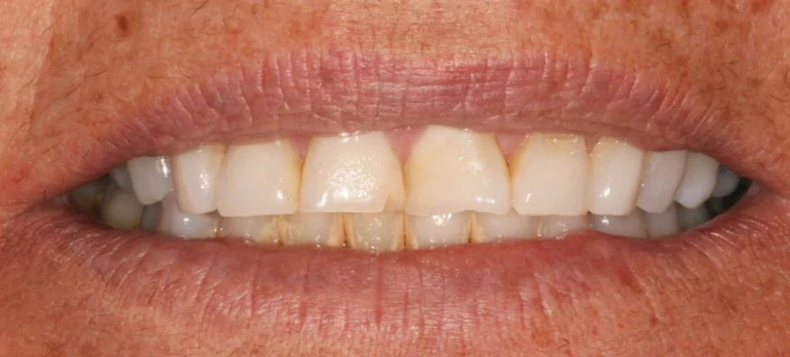 Before Treatment Case 2