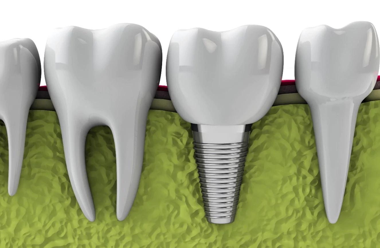Dental Implant Process