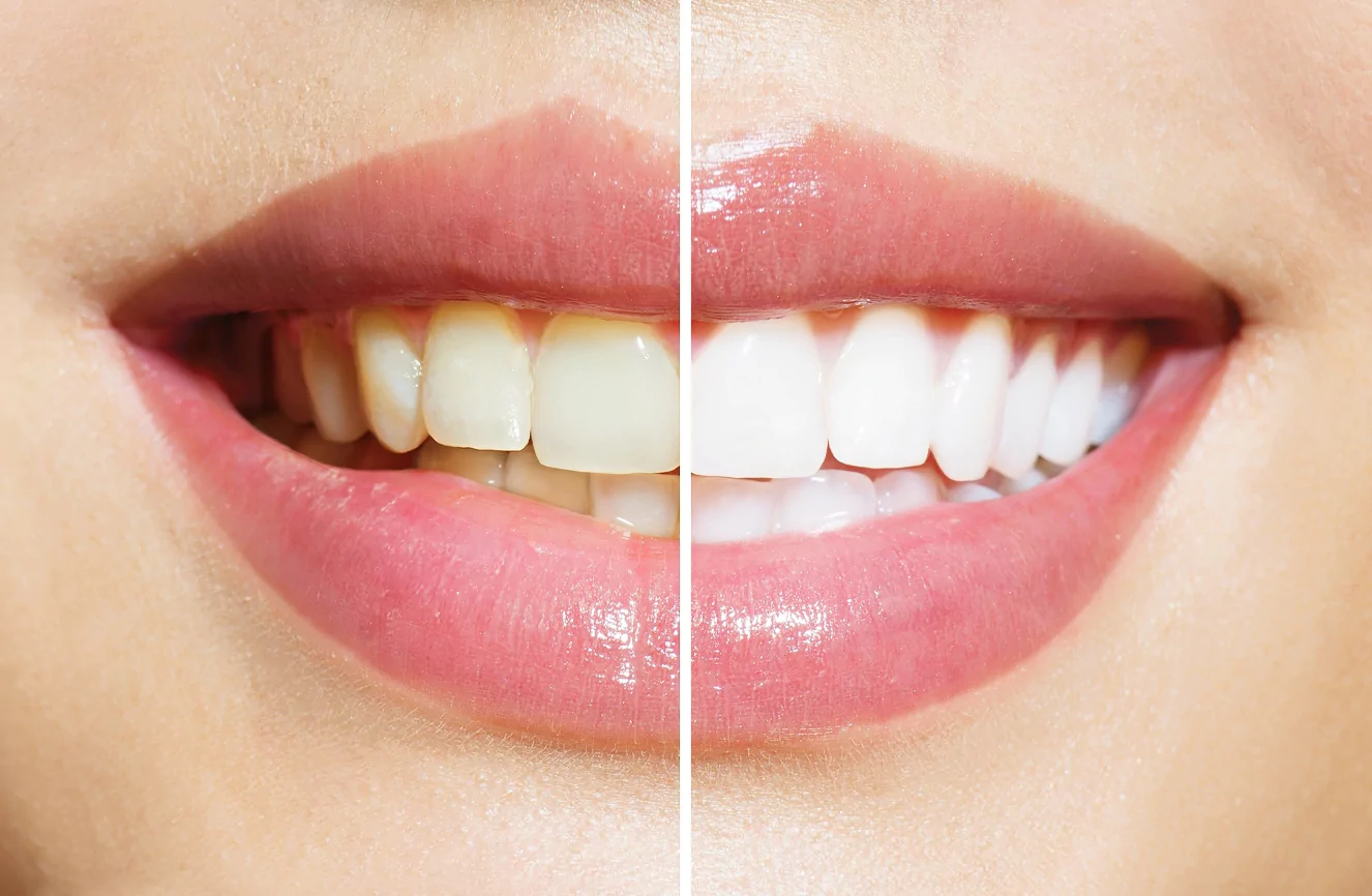 Beautiful Smile Transformation